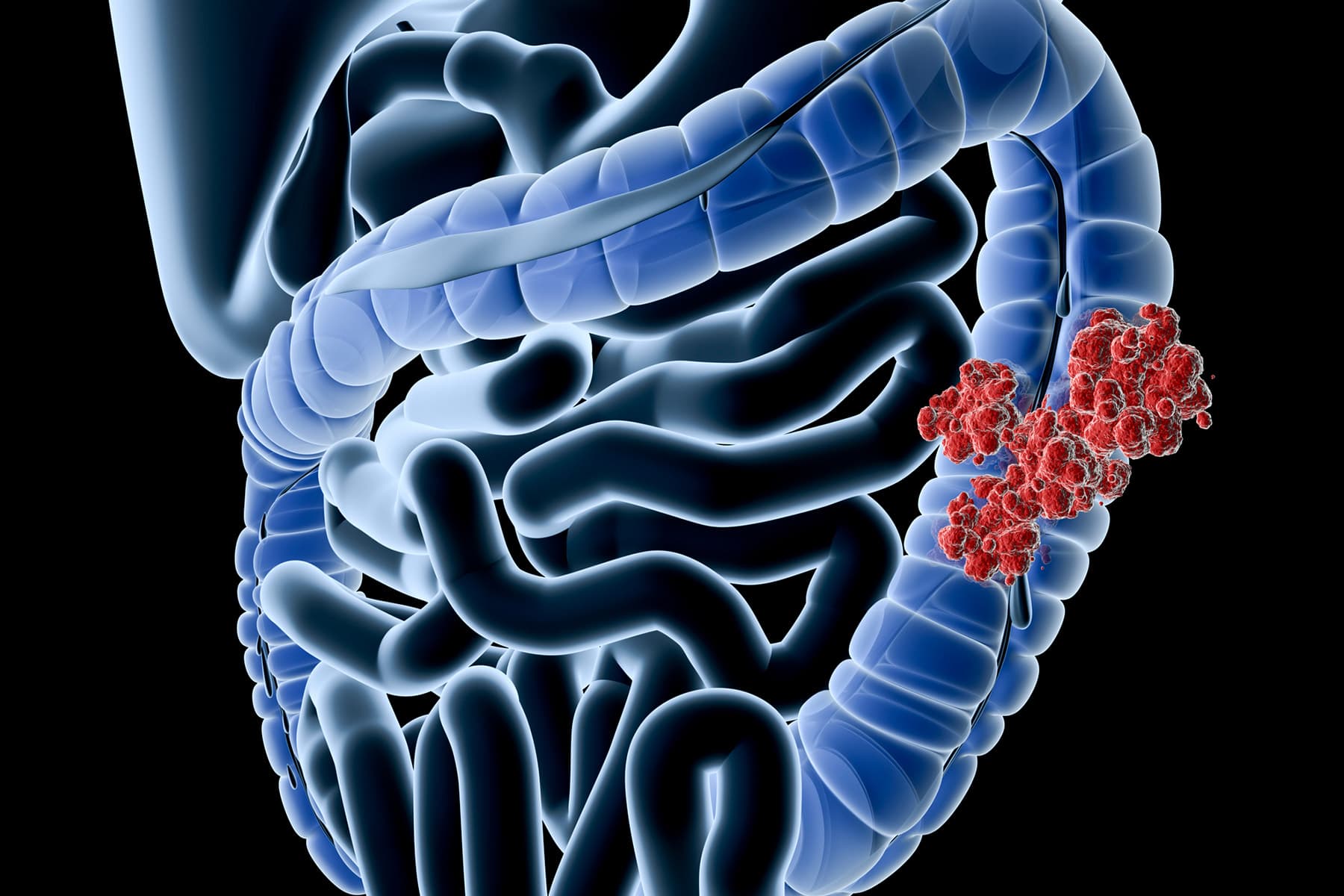 Colon Cancer, Often Avoidable, Hits Black Men, the Young More