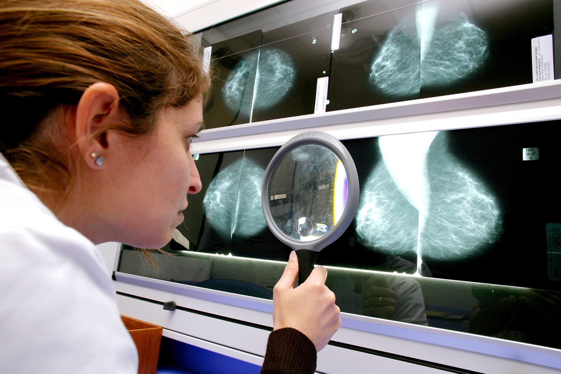 Pandemic Brought Big Drop in Breast Cancer Screenings